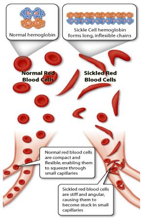 Illustration shows how sickle cell hemoglobin forms long, unflexible chains.
