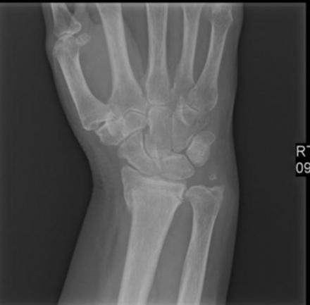 Radiograph image of the left hand and wrist.