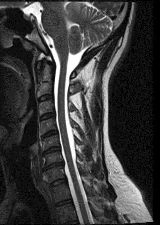 This is a sagittal image slice of Mrs. Farley’s cervical MRI