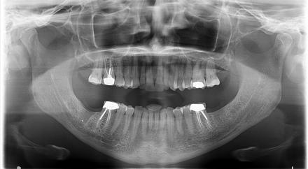 Panorex radiograph of Mrs. Farley’s mouth, jaw joints, and teeth