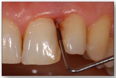 Periodontal inflammation