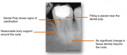 Periodontal radiograph shows signs of calcification, reasonable bony support around the roots, filling placed near the dental pulp, and no significant change in tissue density beyond the roots