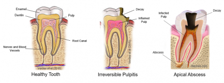 Illustrations of the progress from a healthy tooth through irreversible pulpitis to apical abscessto