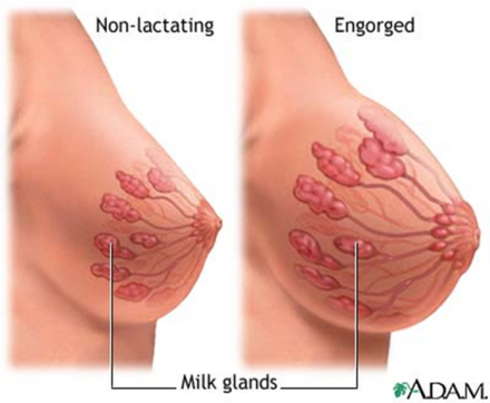 Illustration showing the milk glands of a normal breast compared to an engorged breast.