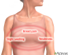 Illustration showing breast pain symptoms. Image provided courtesy of A.D.A.M http://www.adameducation.com/