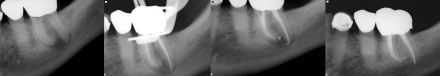 Stages of healing during endodontic treatment