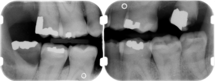 Bitewing radiographs after treatment