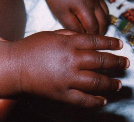 A child's hands swollen with dactylitis