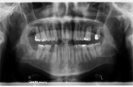 Panograph of Mr. Gateway's Dentition