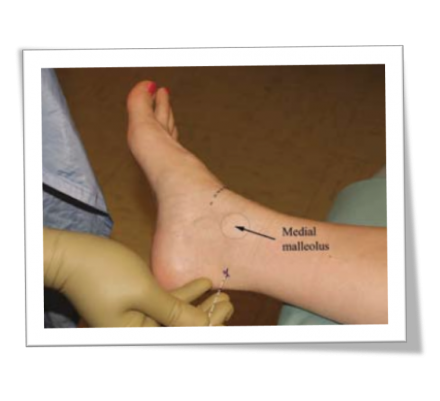 Ankle block needle placement