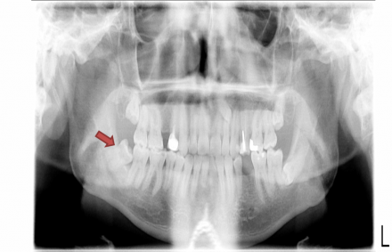 A panograph with four impacted bony wisdom teeth