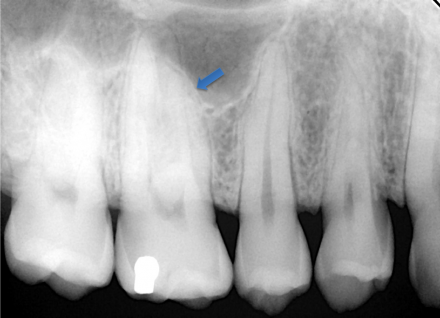 Radiograph that shows proximity of maxillary sinus to first molar