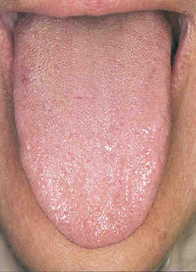 Normal tongue