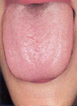 Pale white tongue
