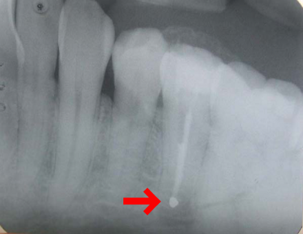 Radiograph of lower right second bicuspid