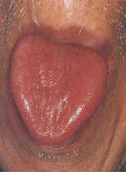 Red tongue