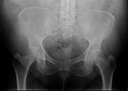 Radiograph image of pelvis