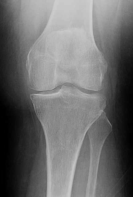 Radiograph image of a knee