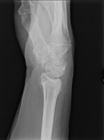 Side view radiograph of the left hand and wrist.