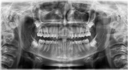 X-Ray of patient with Eagle Syndrome, a cause of oral / facial pain.