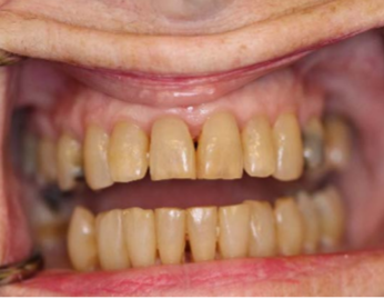 Teeth and gums show inflammation around gumline.