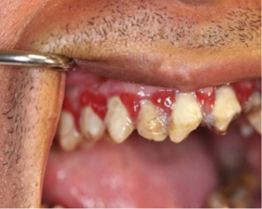 Teeth and gums show multiple broken teeth and severely inflamed gums.