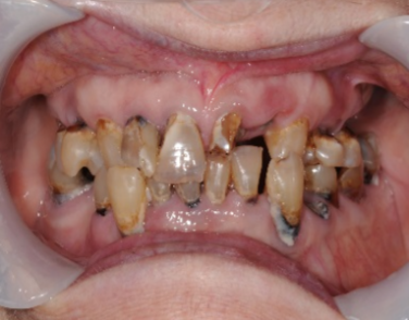 Teeth and gums show multiple broken teeth.