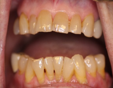 Teeth and gums show good oral hygiene