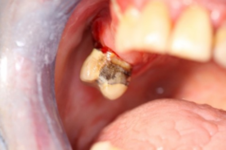 Dental examination showing cavity in tooth with bleeding gum.