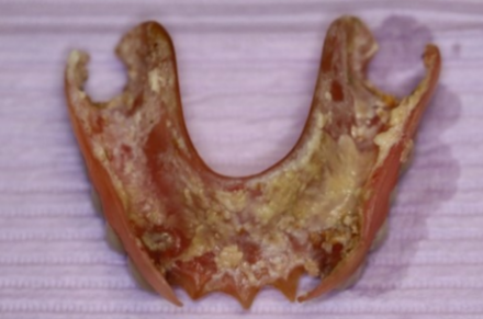 Margaret's denture shows large amounts of soft deposits over the denture base.