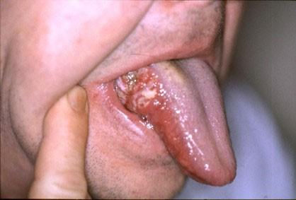 Tongue showing oral cancer