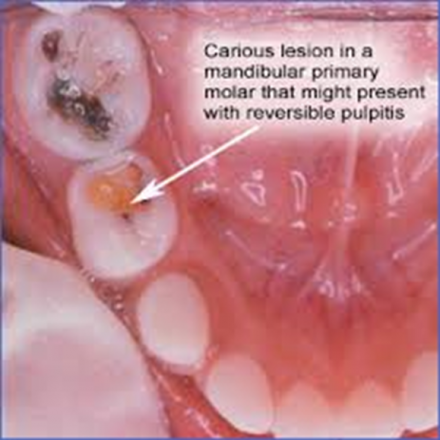 Carious lesion in a mandibular primary molar