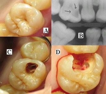 Periapical periodontitis and periapical abscess