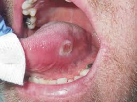 Oral ulceration
