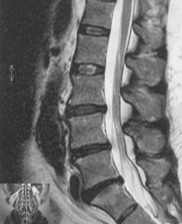 MRI image of a spine