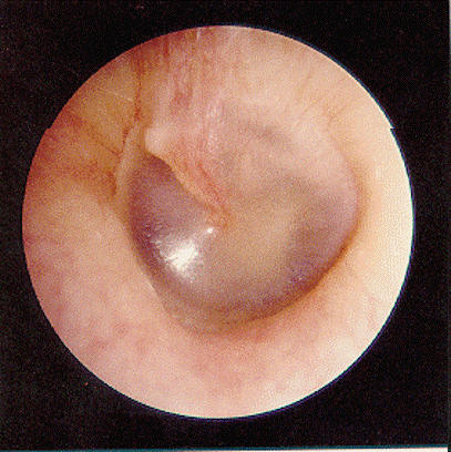 Photo of ear canal