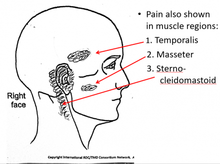 Pain in muscle regions temporalis, masseter and sterno-cleidomastoid