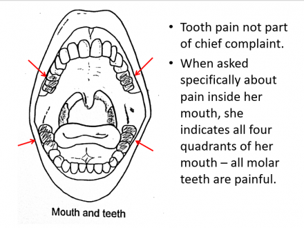 Pain drawing indicating all molar teeth feel painful.