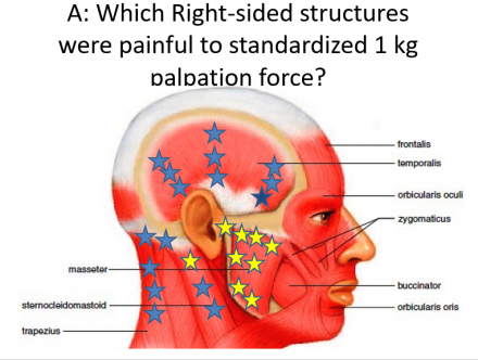 Temporomandibular region painful to palpation