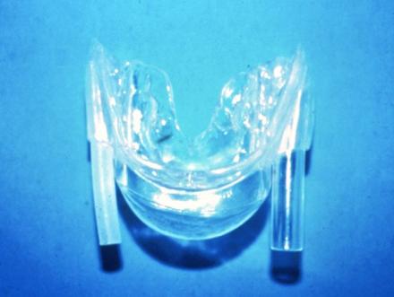 Oral appliance that does not make the mandible protrude