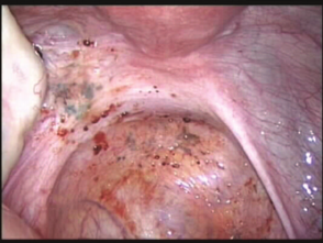 Image of endometriosis