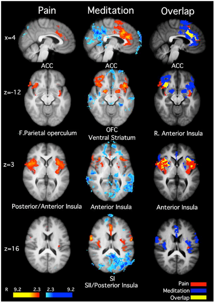 Brain scans showing difference between pain, meditation and overlap.