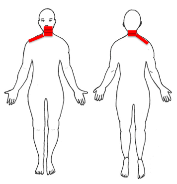 This is an example of a body diagram marked where the patient is experiencing pain, e.g. the mouth, neck and right shoulder