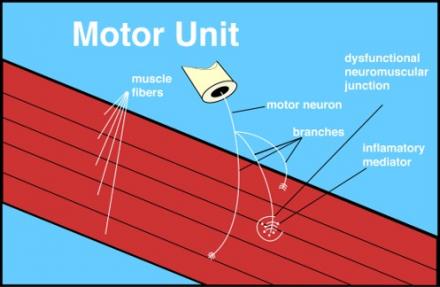 a drawing shows the a muscle motor unit with parts of the unit labeled, i.e.: muscle, neuron, dysfunctional neuromuscular junction, inflammatory mediators