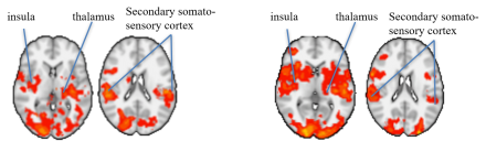 Functional MRI images of areas of brain activation in a patient without pain (control) and with fibromyalgia in response to a painful stimulus. More areas light up in the fibromyalgia patient.