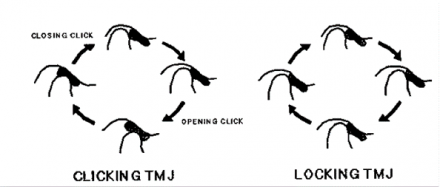 Two diagrams show the TMJ disc position in anterior disc displacement and where the disc is in relation to the condyle with a clicking (disc reduction) and locking (without reduction) TMJ