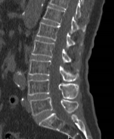 Spine CT