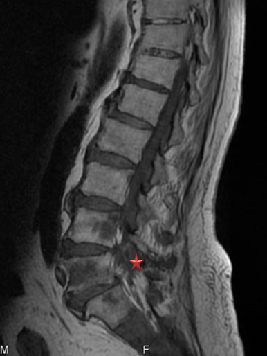 Mid-sagittal MRI
