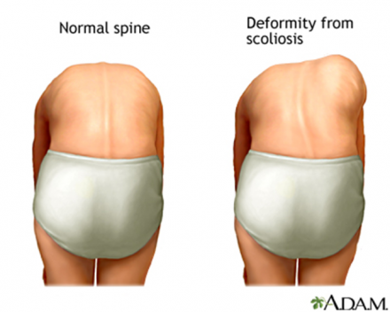 Illustration of a normal spine next to a spine deformed from scoliosis