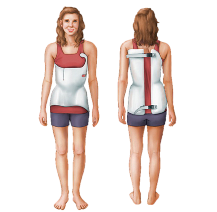 Illustration showing adolescent female wearing a back brace